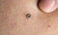 روش‌های از بین بردن خال و زائده‌های گوشتی