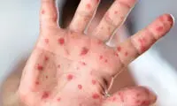 سرخک ۲۹ نفر را در بابل روانه بیمارستان کرد
