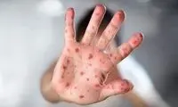 هشدار وزارت بهداشت درباره شیوع یک بیماری 