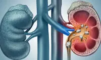 چند توصیه برای پیشگیری از سنگ کلیه در تابستان