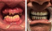 ایمپلنت یک روزه چیست و هزینه آن چقدر است؟