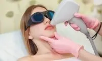 لیزر موهای زائد صورت چگونه انجام می‌شود؟