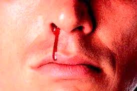 چرا «خونریزی بینی» اتفاق می‌افتد؟