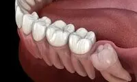 استحکام بالای دندان انسان زیر دستگاه پرس