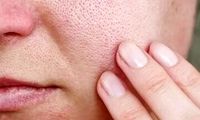 با منافذ باز پوست چه کنیم؟