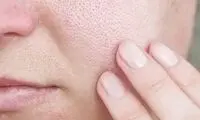 با منافذ باز پوست چه کنیم؟