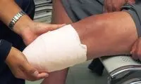 این بیماری می‌تواند منجر به قطع عضو شود