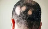 وقتی موهایم بدون اجازه من را ترک کردند!