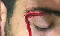 جراحت چشم شجاع در دیدار با نسف‌قارشی