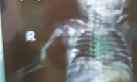 ماجرای تولد نوزاد خرمشهری با دست شکسته