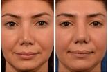 عمل ترمیم بینی چیست و در چه مواردی به کار برده می‌شود؟