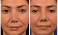 عمل ترمیم بینی چیست و در چه مواردی به کار برده می‌شود؟