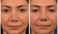 عمل ترمیم بینی چیست و در چه مواردی به کار برده می‌شود؟