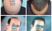پیکر تراشی (بادی جت) چیست؟