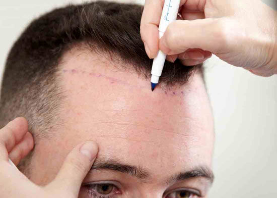 کاشت مو به روش AMT چیست؟