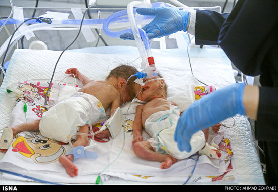 عکس: تولد دوقلو‌های به هم چسبیده در قم