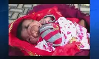 نوزادی با خرطوم فیل به دنیا آمد! +عکس