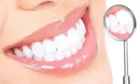 اصلاح طرح لبخند با کامپوزیت + مزایا و معایب
