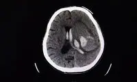 آنوریسم مغزی؛ علل و علائم و درمان
