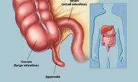 آپاندیس و عوارض آن را خیلی جدی بگیرید!