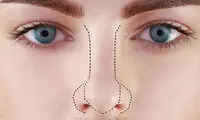 فرم‌دهی بینی بدون جراحی امکان پذیر است؟ + معرفی 10 روش کاربردی