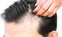 بهبودیافتگان کرونا مراقب ریزش شدید مو باشند