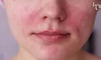 چگونه قرمزی صورت را برطرف کنیم؟