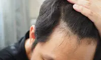 دلایل ریزش مو در مردان؛ هراسِ کچلی