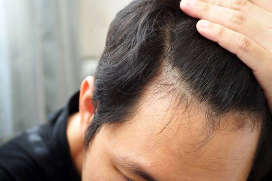 دلایل ریزش مو در مردان؛ هراسِ کچلی