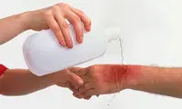 رایج ترین علل سوختگی و راهکارهای پیشگیری از آن