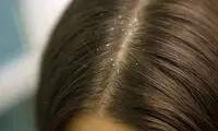 شوره‌سر یا شپش؛ از علائم تا درمان