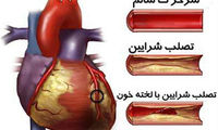 چه کسانی به تصلب شرایین مبتلا می‌شوند؟