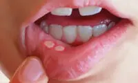 با کمبود این ویتامین ها آفت دهان می زنید