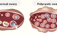 تخمدان پلی کیستیک، زنان را نازا می‌کند؟