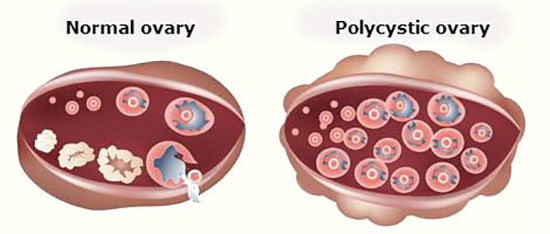 تخمدان پلی کیستیک، زنان را نازا می‌کند؟