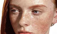 چگونه از ایجاد کک و مک جلوگیری کنیم؟