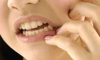 طب سنتی؛ بهترین روش درمان آفت دهان