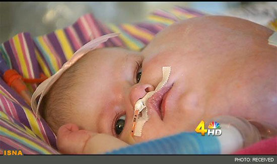 بیماری نادر و دردناک نوزاد آمریکایی +عکس