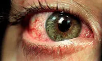 رایج ترین علل قرمزی چشم