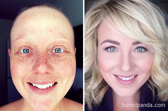 عکس‌های قبل و بعد کسانی که با سرطان مبارزه کردند