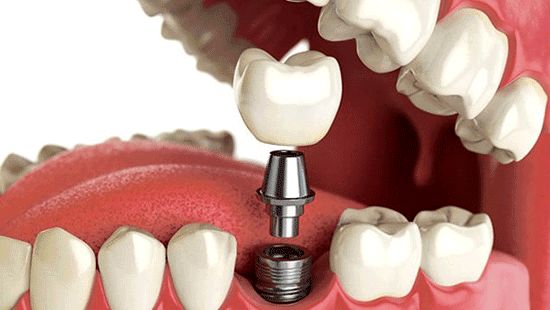 ایمپلنت دندان در کلینیک دندانپزشکی ایثار 