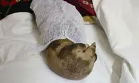 دختر بنگلادشی ۱۲ ساله‌ با بیماری نادر «مرد درختی»
