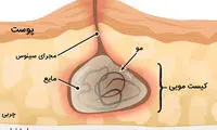 علائم، علل و راه‌های درمان کیست مویی