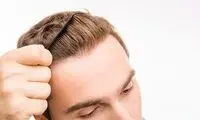 مزایا و معایب کاشت مو به روش fit چیست؟
