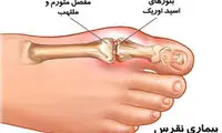 نقرس، بیماری مردافکن!