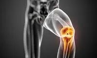 با درد آرتروزتان چه‌ کنید؟