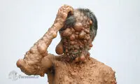تومورهای حبابی مرد بنگلادشی (16+)