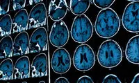 تشخیص افسردگی با تصویر MRI مغز
