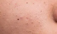 ترکاندن جوش‌ها ممنوع!
