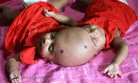 دوقلوی عجیب الخلقه بنگلادشی